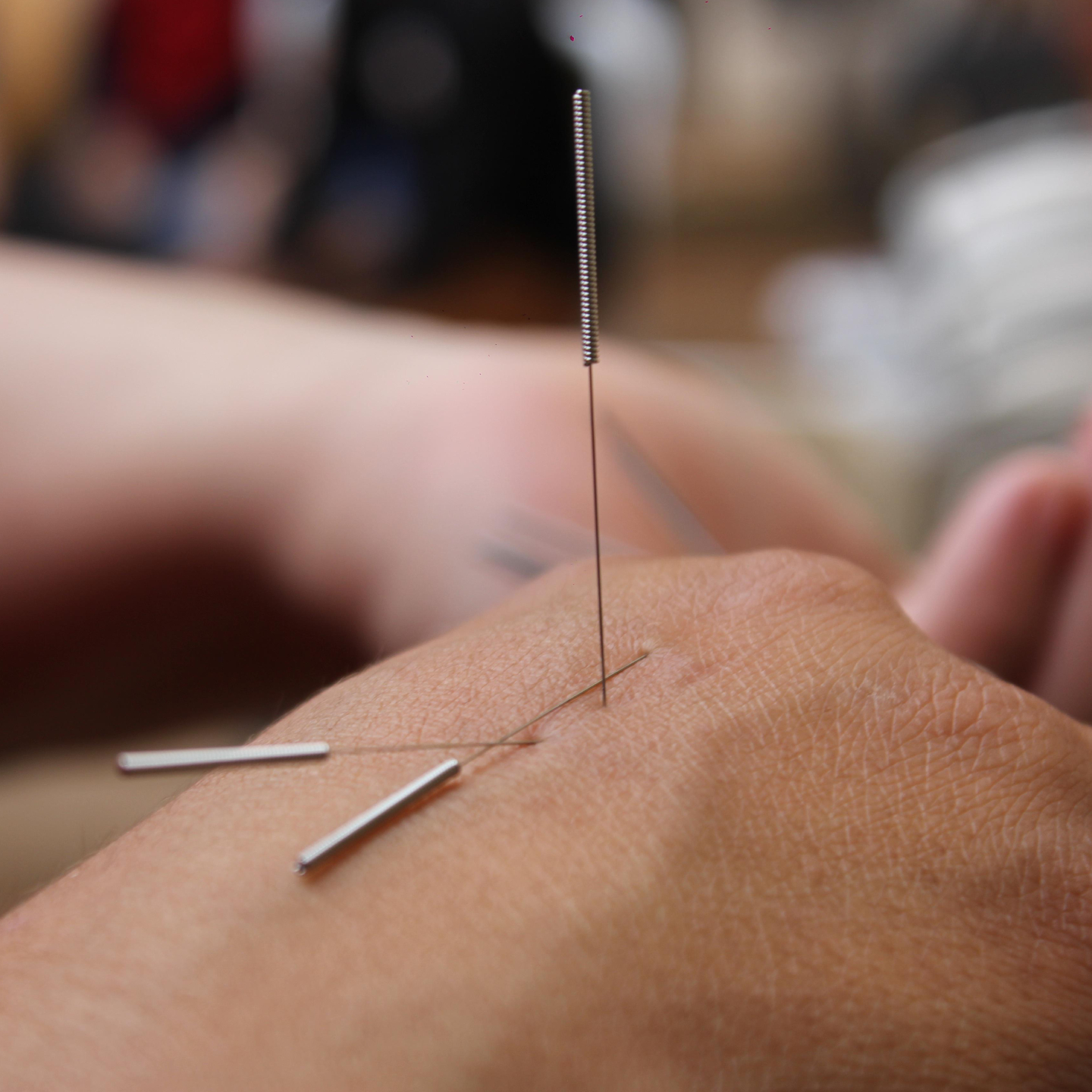 Medical acupuncture treatment using sterile acupuncture needles to relieve pain, reduce inflammation, promote healing, and restore function at ActiveCare Physical Therapy in Midtown Manhattan, New York City.